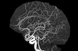 Искусственный интеллект научили выявлять сужение мозговых артерий